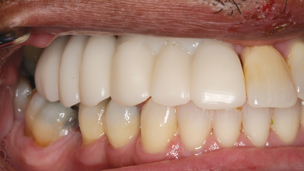 Figures 12a: The PMMA try-in prosthesis was created by the lab to help fine-tune the contours and occlusion. This allowed any necessary adjustments to easily be made to the prosthetic design prior to milling the final BruxZir restoration. The patient was also involved in making any esthetic changes to the try-in prosthesis.