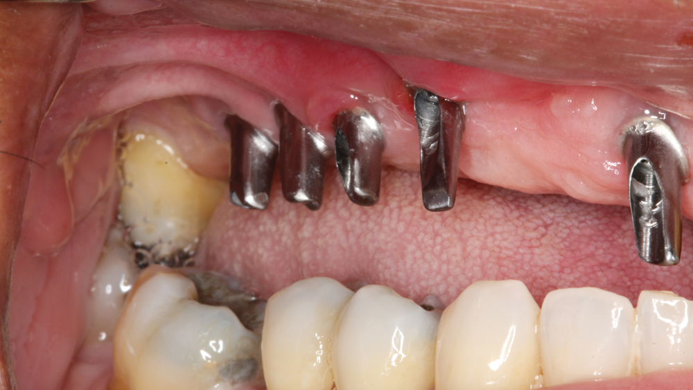 Figures 11b: Inclusive Custom Abutments were fabricated with gingival or slightly subgingival margins. The abutments were delivered using lab-created seating jigs to ensure proper orientation, and the prosthetic screws were tightened to 35 Ncm. Proper torque is critical to preventing abutment loosening over time.