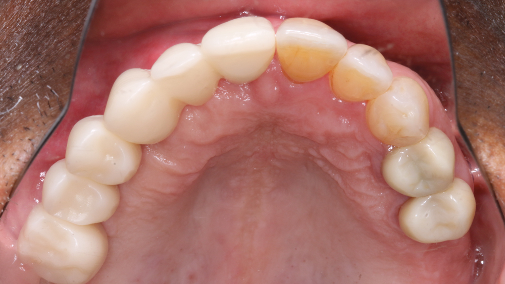 Figures 12b: The PMMA try-in prosthesis was created by the lab to help fine-tune the contours and occlusion. This allowed any necessary adjustments to easily be made to the prosthetic design prior to milling the final BruxZir restoration. The patient was also involved in making any esthetic changes to the try-in prosthesis.