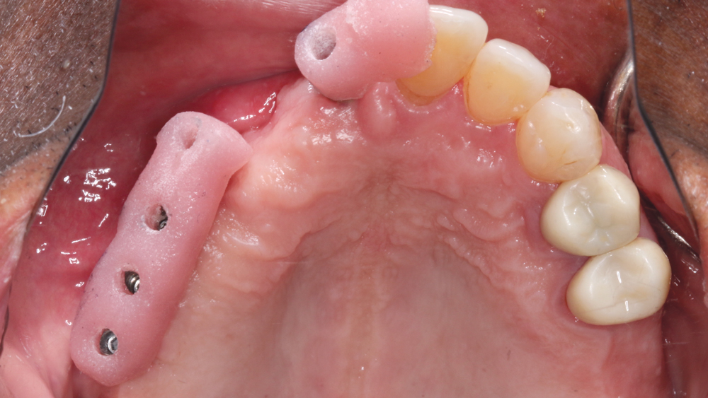 Figures 11a: Inclusive Custom Abutments were fabricated with gingival or slightly subgingival margins. The abutments were delivered using lab-created seating jigs to ensure proper orientation, and the prosthetic screws were tightened to 35 Ncm. Proper torque is critical to preventing abutment loosening over time.
