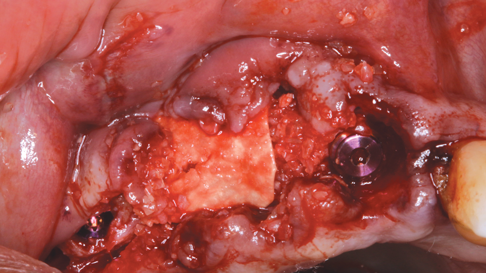 Figures 7b: Newport Biologics Cortico/Cancellous Allograft Blend was placed firmly but carefully, and the membrane was passively tucked facially and palatally.