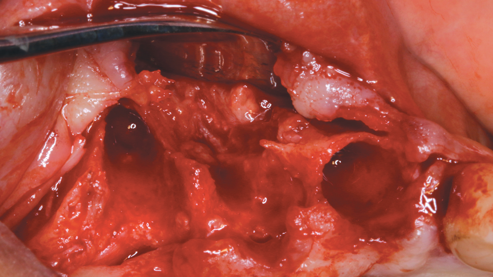 Figure 4Figure 4: The teeth were removed, and the soft tissue was reflected to expose the defective bone contours prior to implant placement.