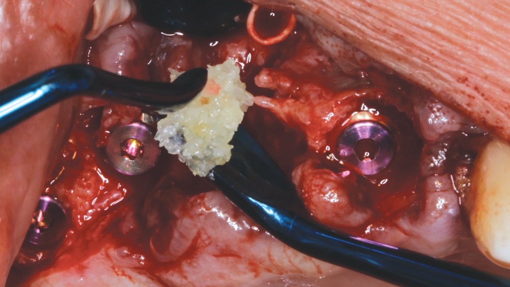 Figures 7a: Newport Biologics Cortico/Cancellous Allograft Blend was placed firmly but carefully, and the membrane was passively tucked facially and palatally.