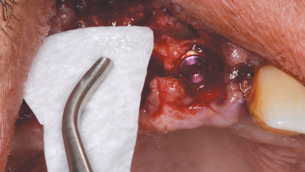 Figure 6: A Newport Biologics Resorbable Collagen Membrane 3-4 was cut to size to extend beyond the defect, which would be corrected with allograft material. The membrane prevents invagination of epithelial tissue into the healing wound.