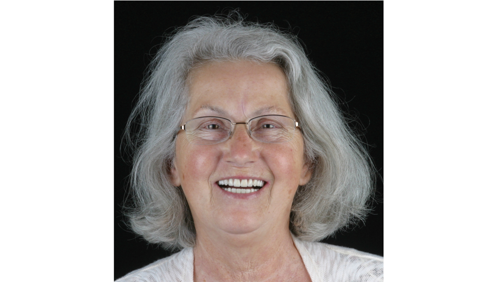 after image of patient transformation provided by the new maxillary complete denture and the mandibular full-arch BruxZir restoration