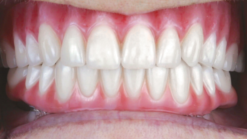 final BruxZir Full-Arch Implant Prosthesis