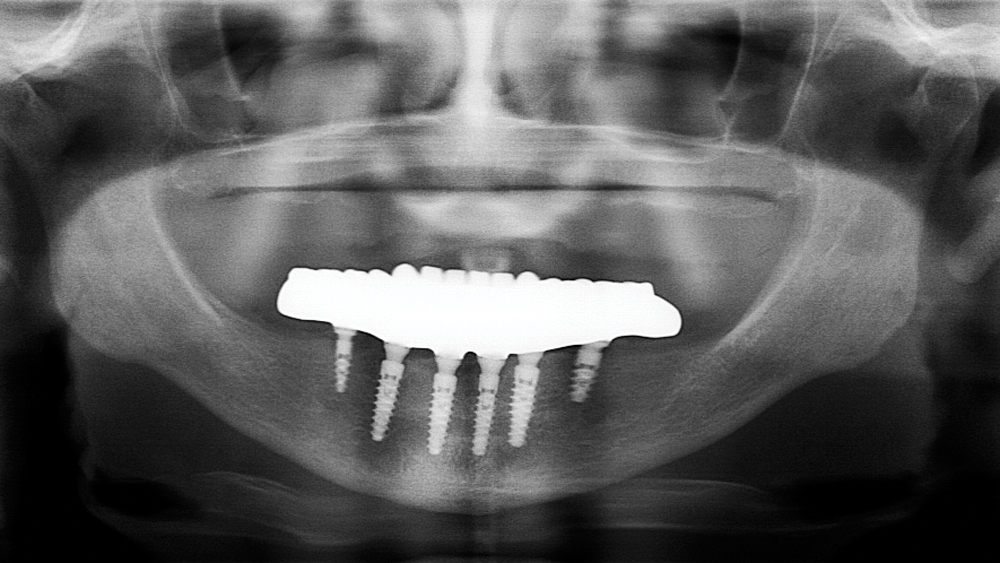 final BruxZir Full-Arch Implant Prosthesis