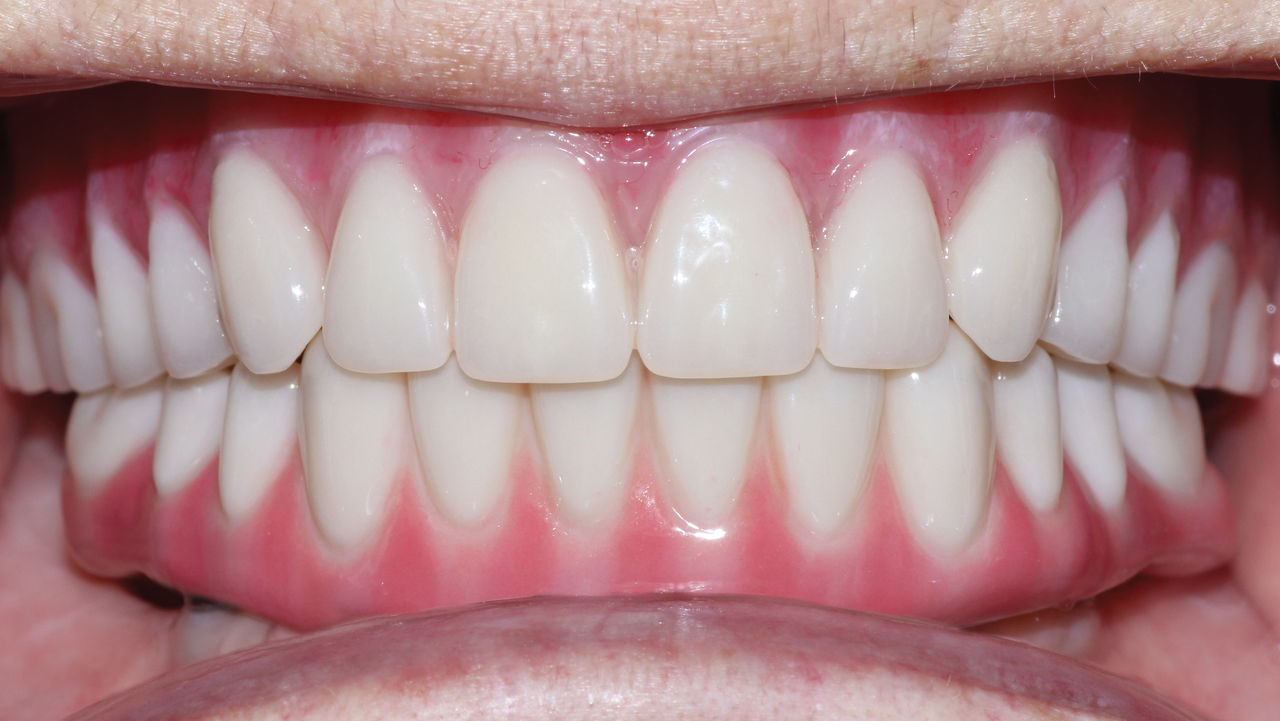 final upper denture is seated 