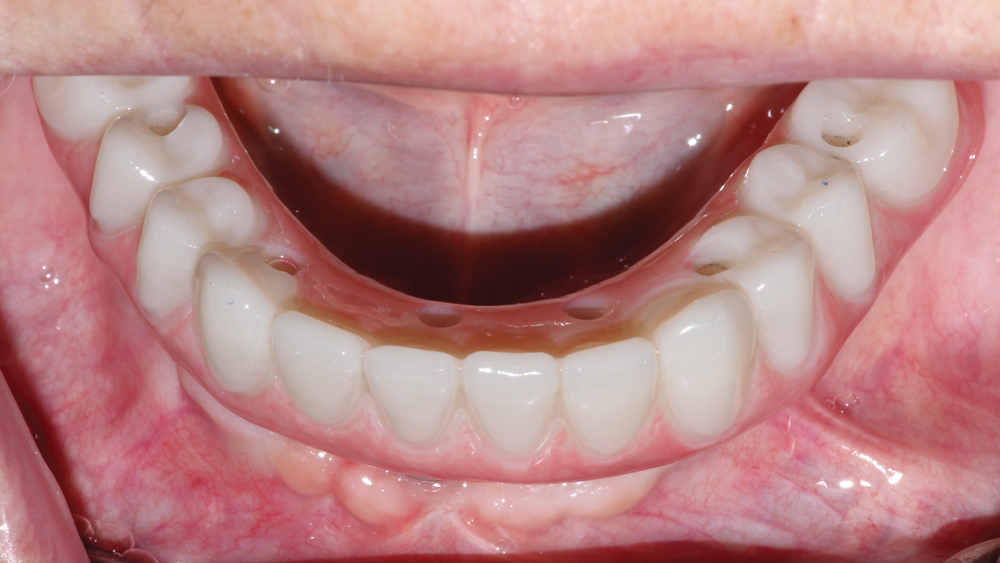  provisional implant prosthesis was tried in and achieved an accurate fit due to the precision of the CAD/CAM copy-mill process on patient
