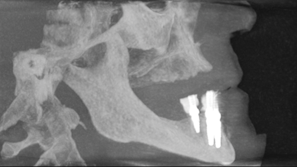 Postoperative CBCT scans illustrate the six axially placed Hahn Tapered Implants