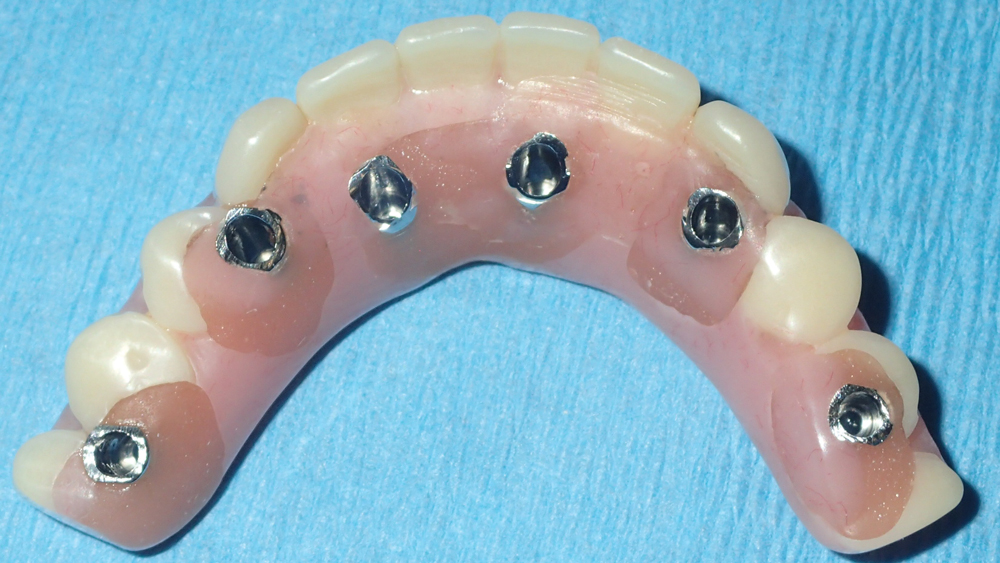  immediate denture was modified to serve as a fixed provisional prosthesis by adding and trimming temporary cylinders