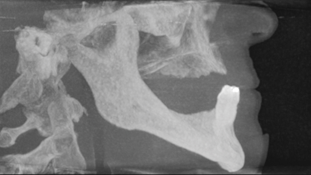 CBCT scanning confirmed sufficient bone volume for the placement of six implants in the mandible