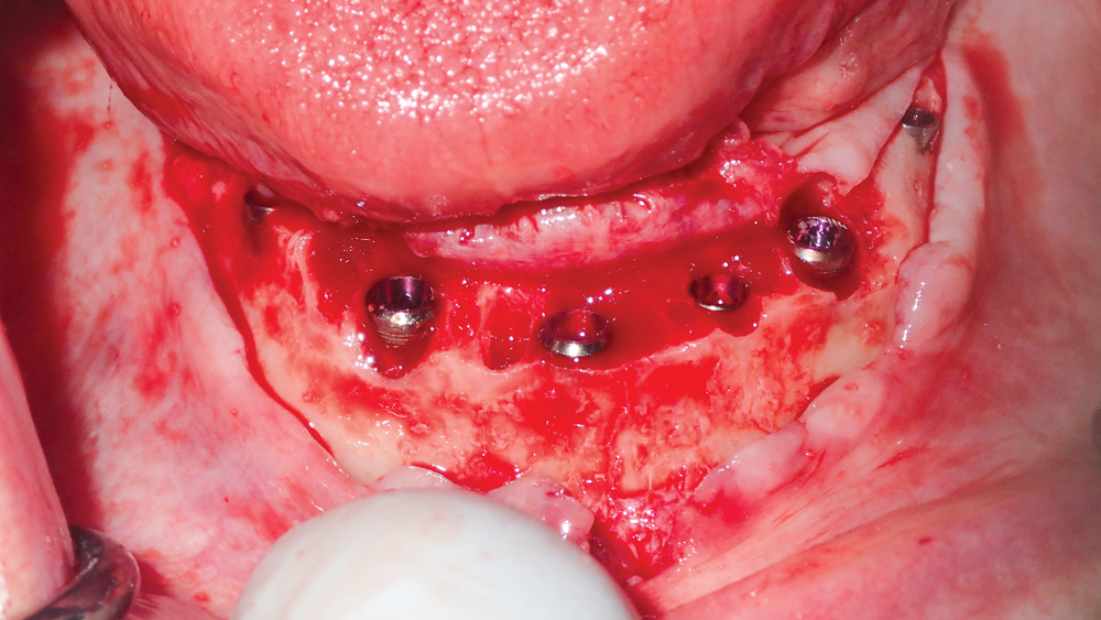 Hahn Tapered Implants selected for surgical procedure