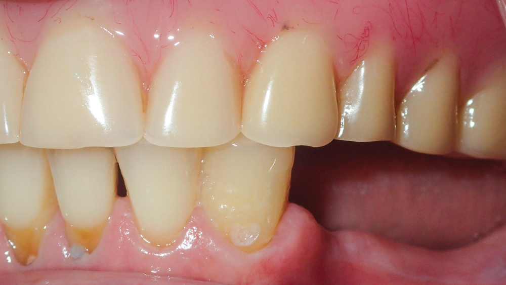 : Lateral views illustrate ridge resorption and thin soft tissue in the posterior areas of the mandible