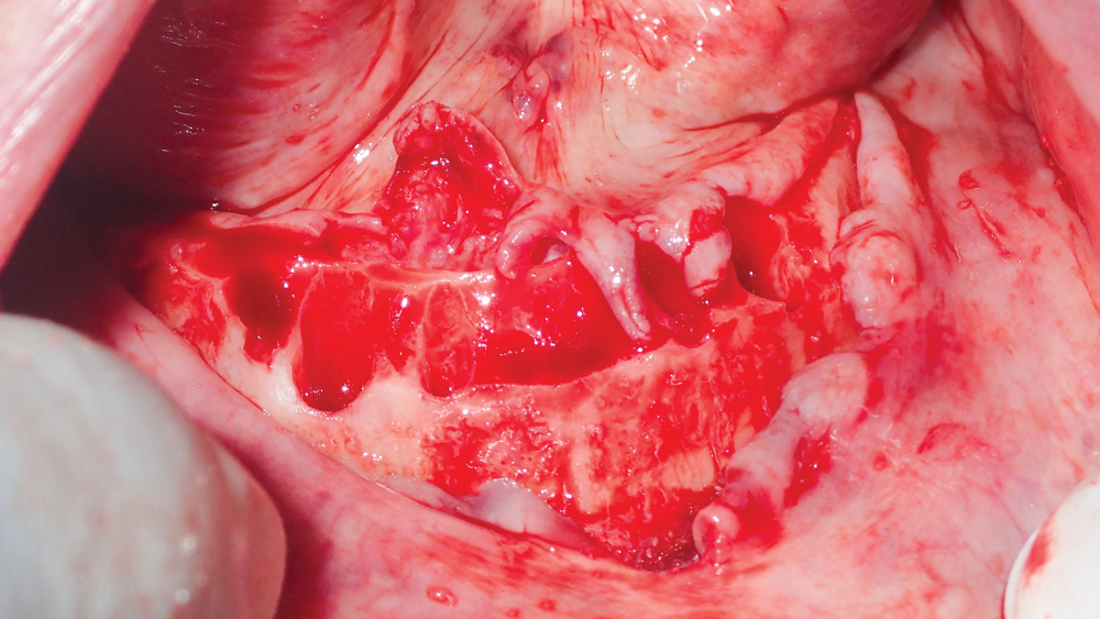 extraction with immediate implant placement