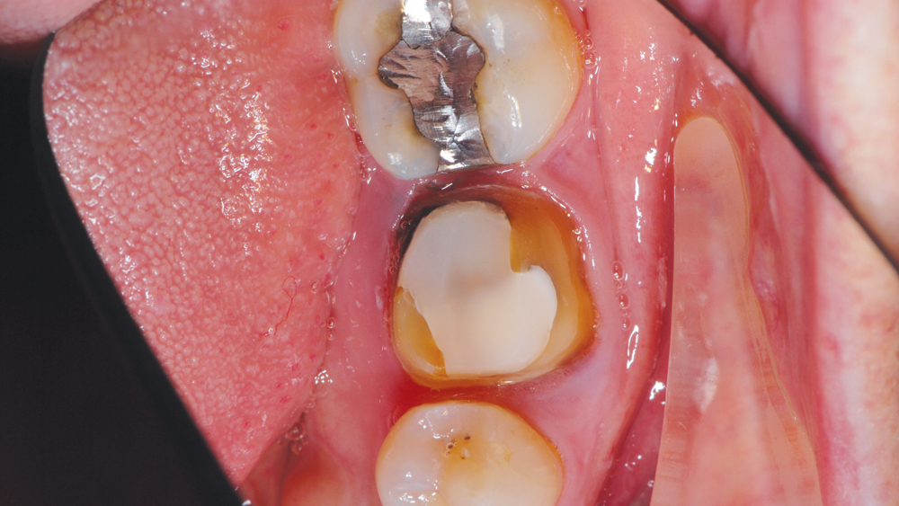 A new core and a direct base for the restoration were placed using composite resin material