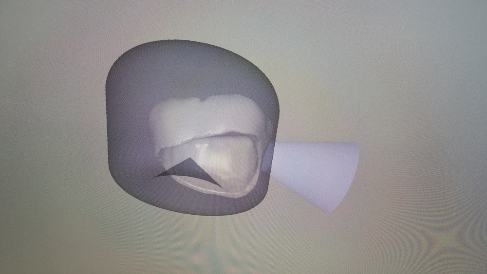 fastdesign.io software processes the case including the creation of the sprue placement