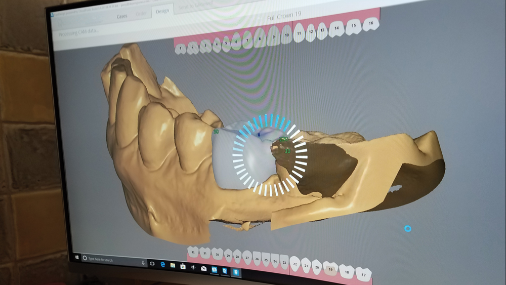 Figure 12a: crown design finalized