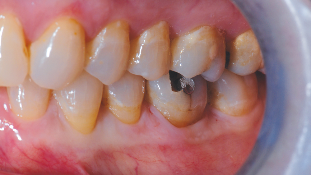 Figure 1b: Initial condition of patient with cusp fracture and missing portion of amalgam