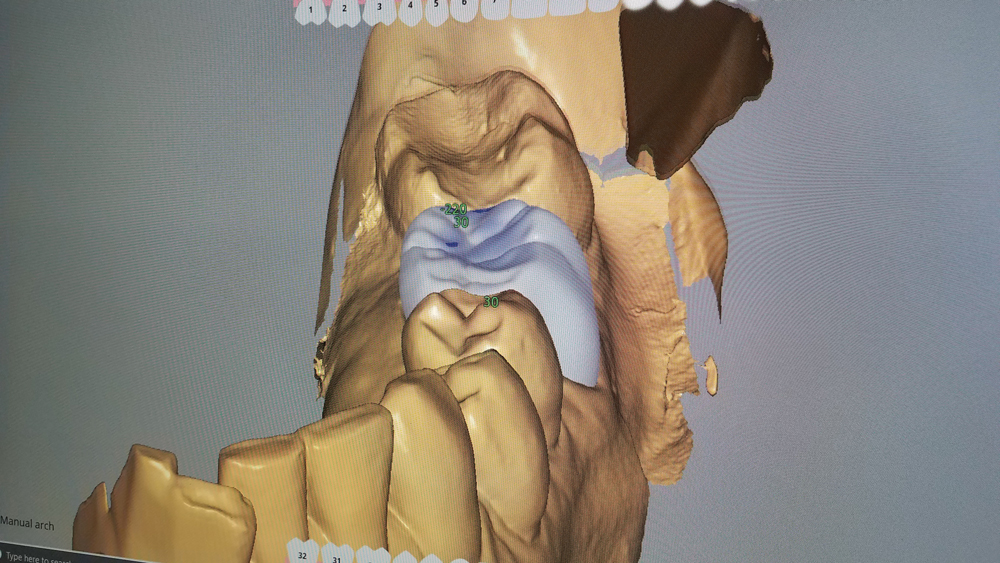 Slight alterations were made to the cusps and occlusion of the proposed crown design