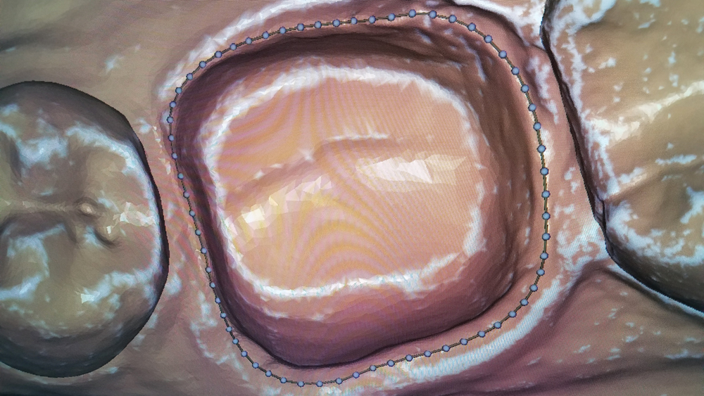 Scan is sent to fastdesign.io Software to process the model and begin the restoration design process