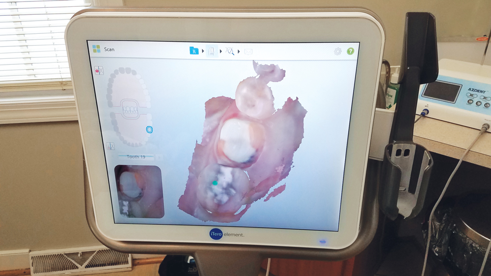 iTero Element scanner software close up of virtual model