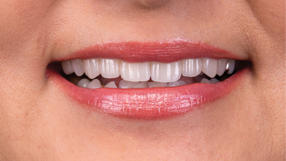 Patient after Obsidian Ceramic