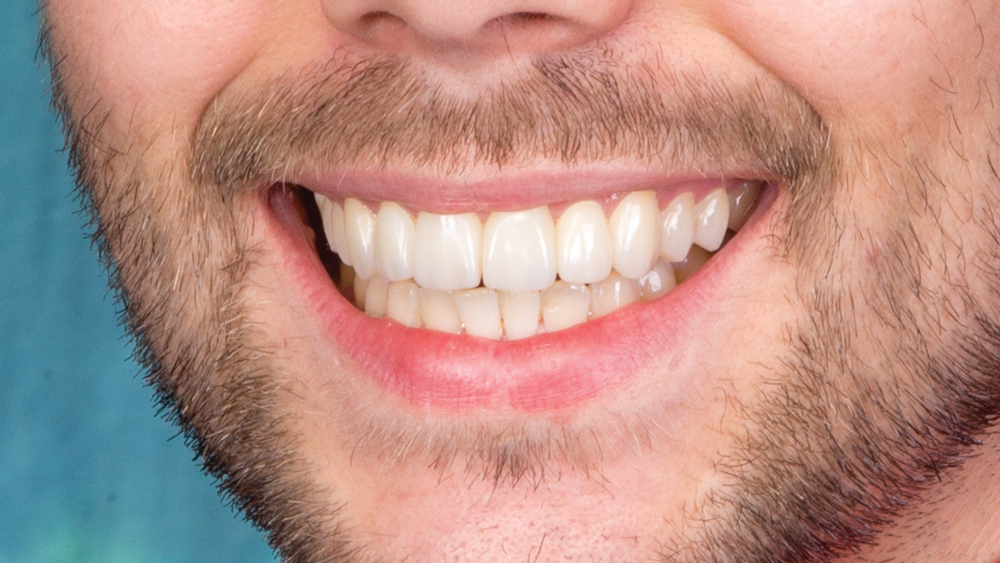 Patient image after BruxZir