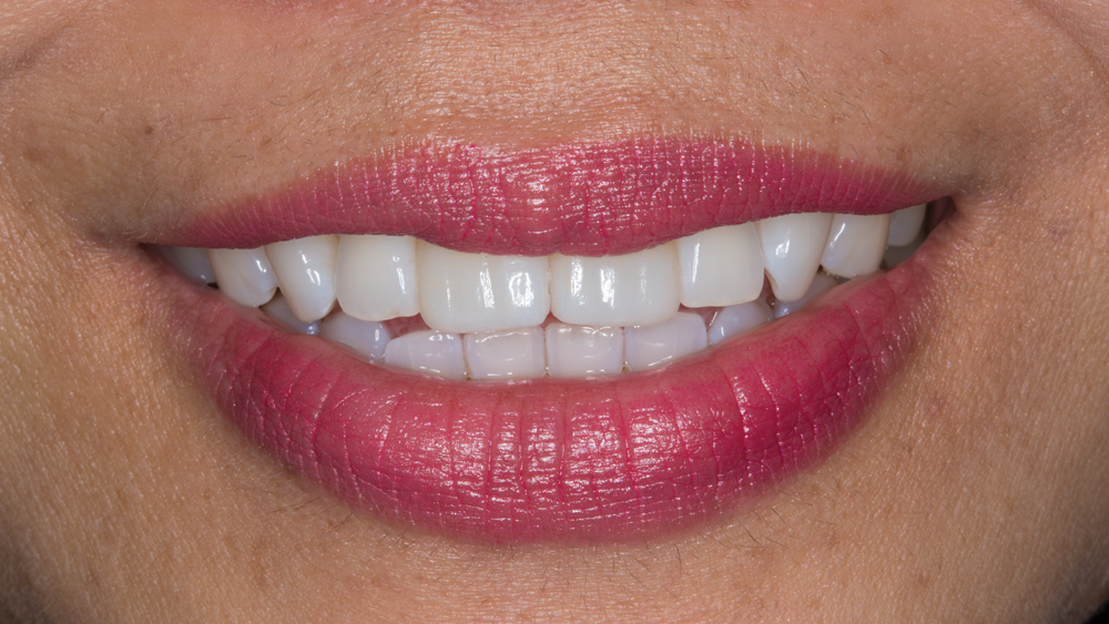 After image of patient with Obsidian Ceramic