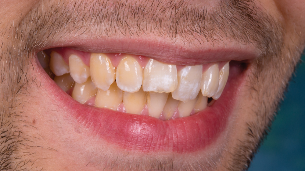 Patient image before BruxZir