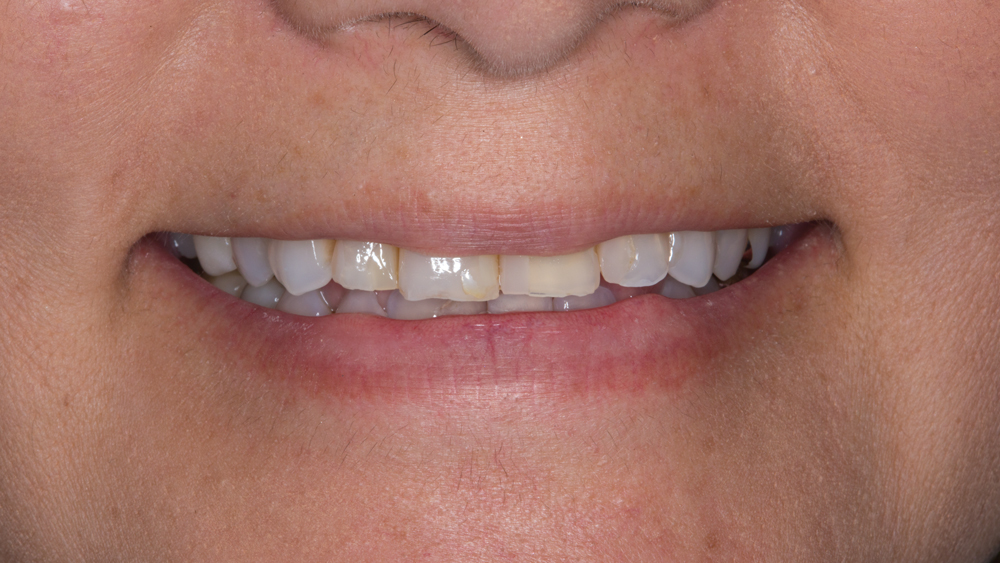 Patient image before Obsidian Ceramic