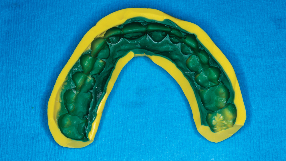 Acrylic mock-up of planned veneers