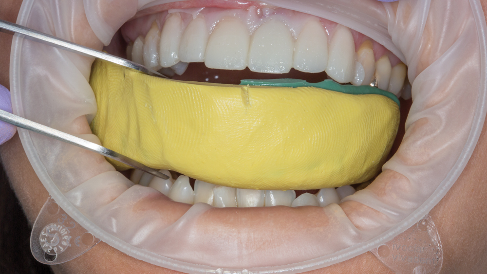 Mold is then removed from patient