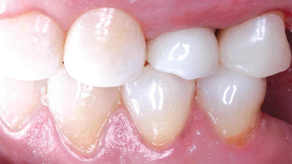 CAMouflage NOW restoration