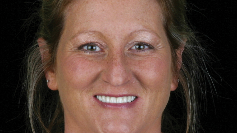 After photo of patient result after implant therapy and BruxZir full-arch restoration