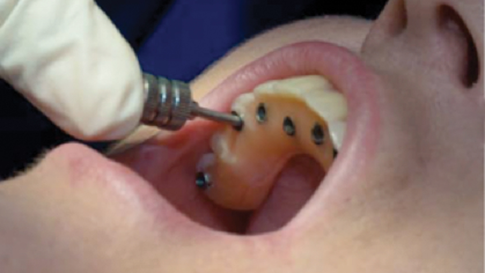 Screw access holes are sealed with Capture® VPS Impression Material