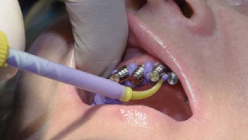 preliminary impression was made with open-tray transfer copings in place of patient's mouth