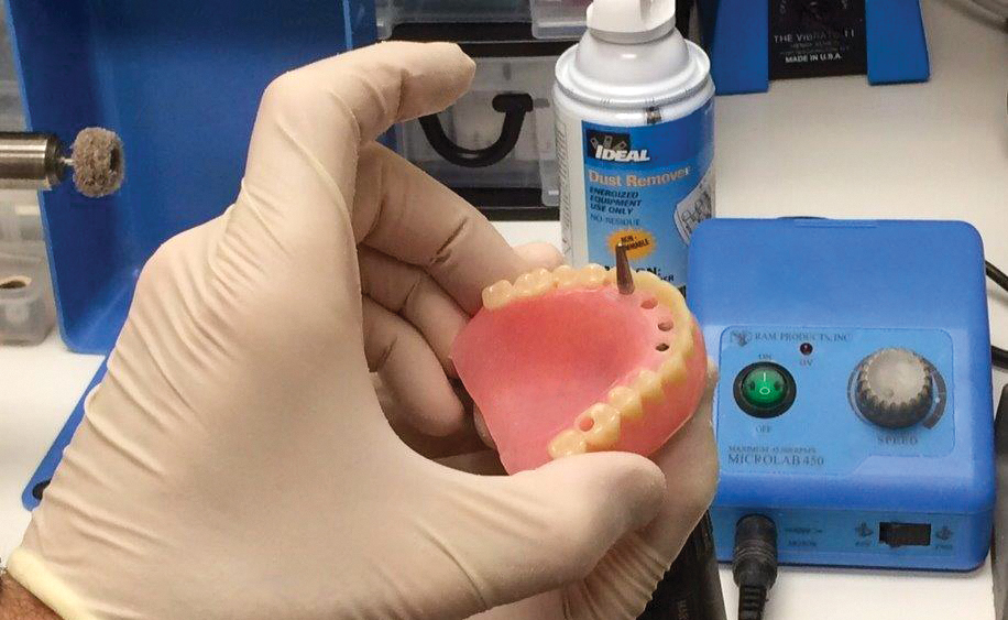 fixed provisional denture to implants