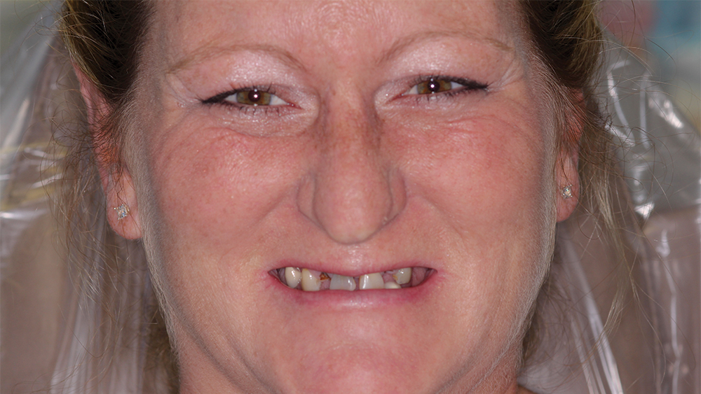 Patient before implant therapy