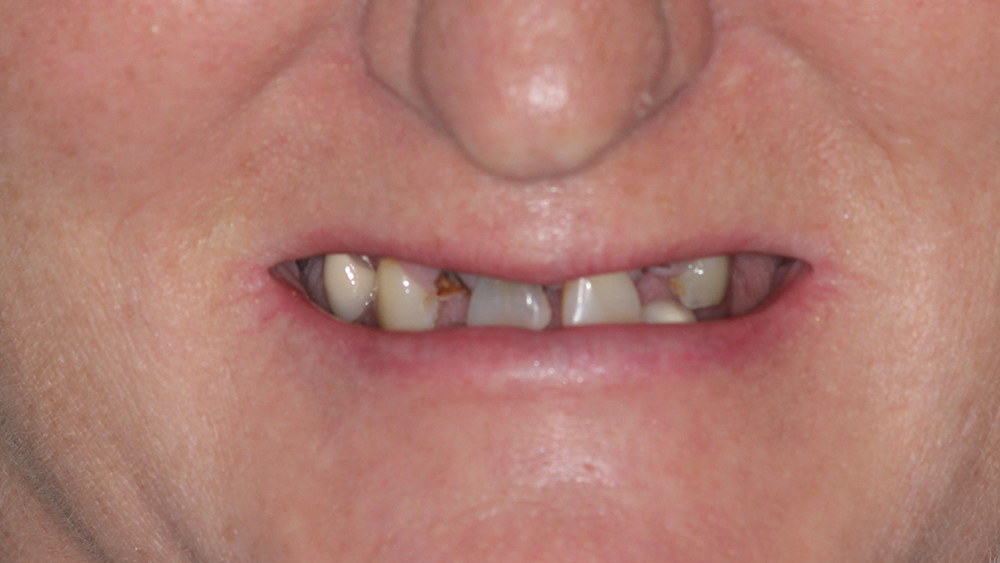 Preoperative extraoral image of the patient with terminal dentition and poor esthetics and function