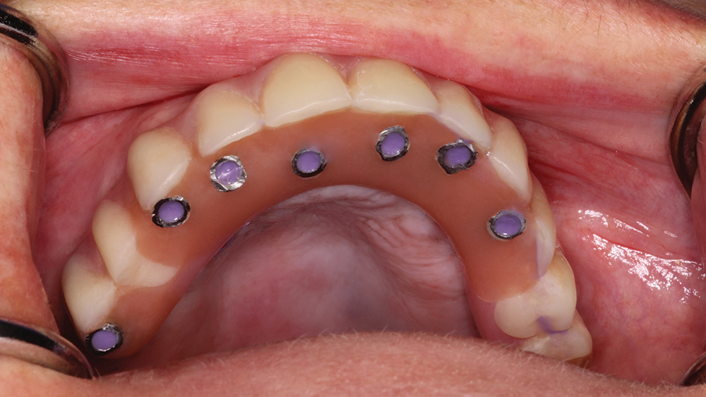 fixed provisional denture