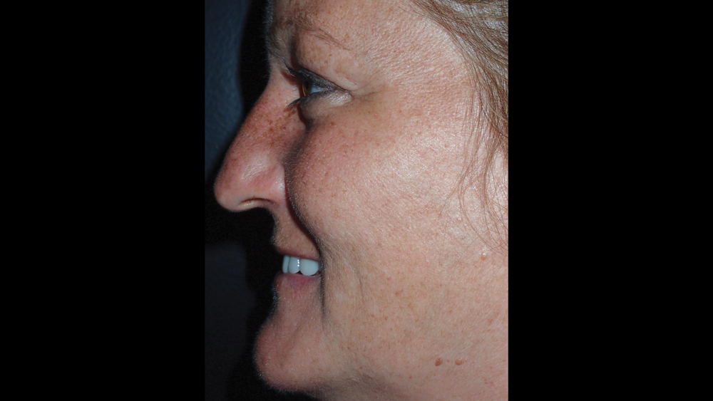 Side-view of patient's molar-to-molar provisional implant prosthesis