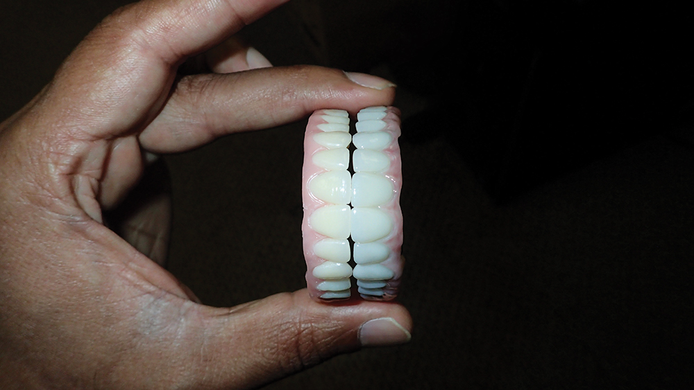 provisional implant prosthesis