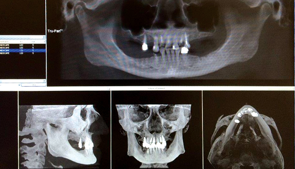 CBCT scan