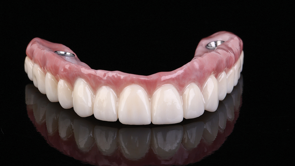 PMMA provisional implant prosthesis