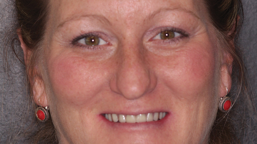 patient's smile with fixed provisional denture