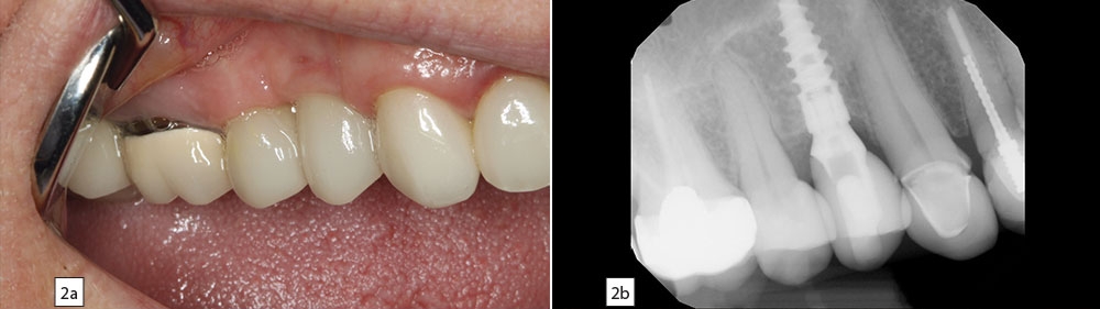 screw-retained crown delivered