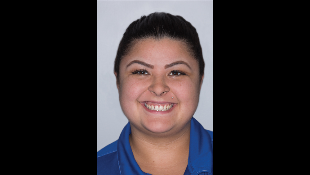 Before photo of patient prior to having bruxzir esthetic