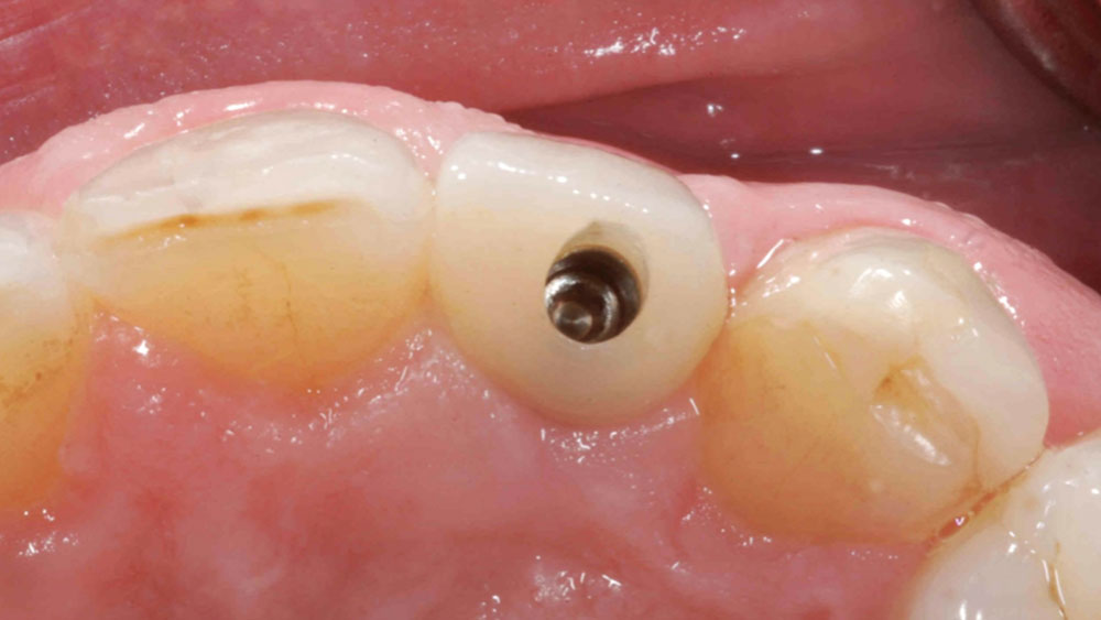 crown delivered and aligned with soft-tissue contours