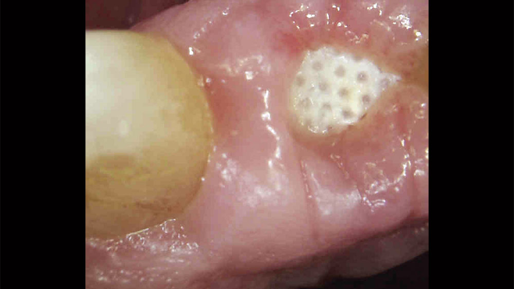 extraction site where socket was grafted with Newport Biologics Mineralized Cortico/Cancellous Allograft Blend